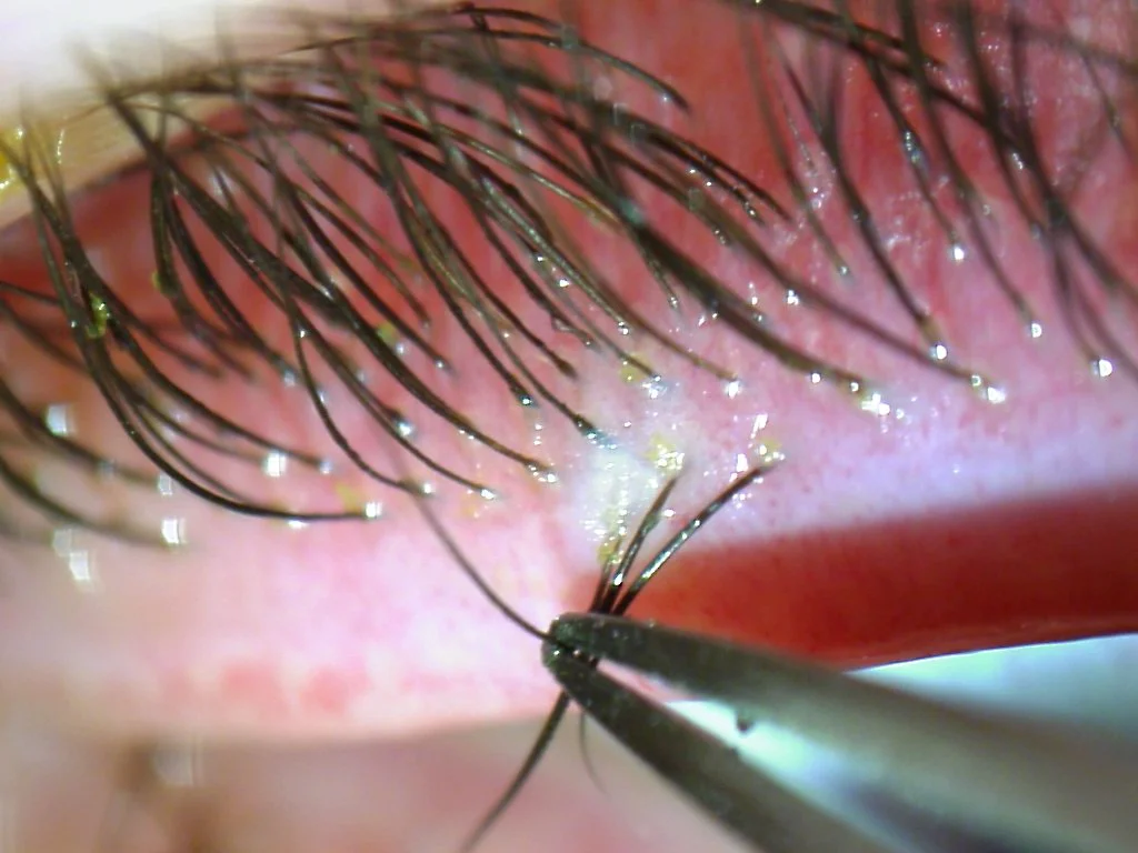 Demodex Blepharitis Treatment: How SkinDerx Eye Cleansing Foam Eliminates Eyelid Mites