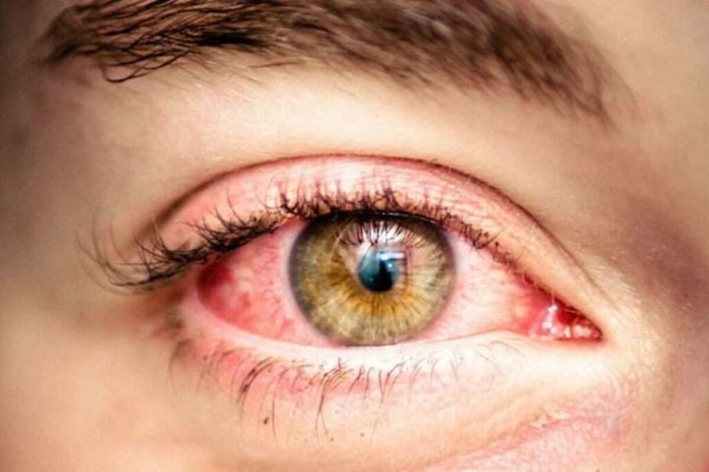 Chronic Dry Eyes? SkinDerx’s Revolutionary Approach to Treating Meibomian Gland Dysfunction